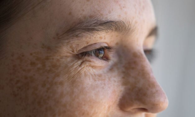 3 Ingredients For Treating Hyperpigmentation, From Professionals