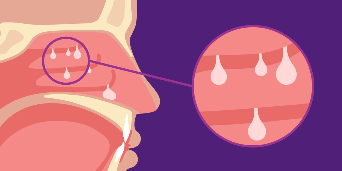 Type 2 Disease and Nasal Polyps