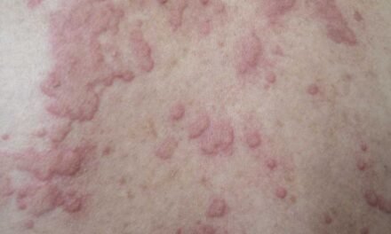 HealthyWomen- HealthyWomen- Serious Unplanned Urticaria 101