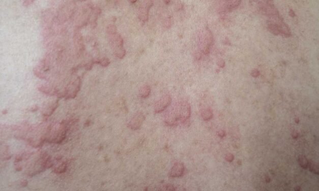 HealthyWomen- HealthyWomen- Serious Unplanned Urticaria 101