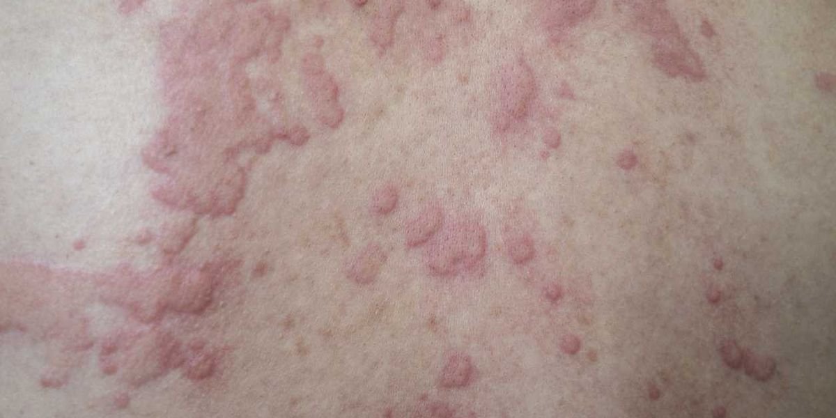 HealthyWomen- HealthyWomen- Serious Unplanned Urticaria 101