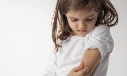 Controlling Pediatric Atopic Dermatitis