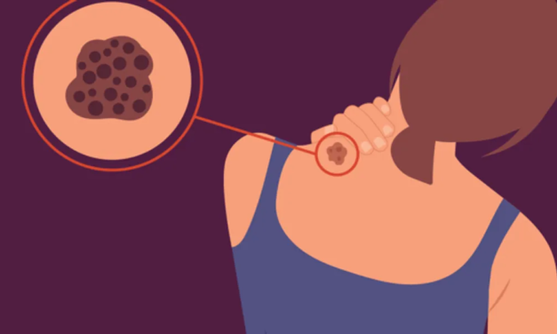 HealthyWomen- Tissues de Melanoma