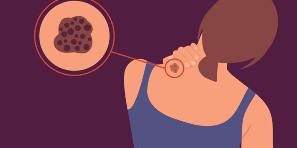 HealthyWomen- Tissues de Melanoma