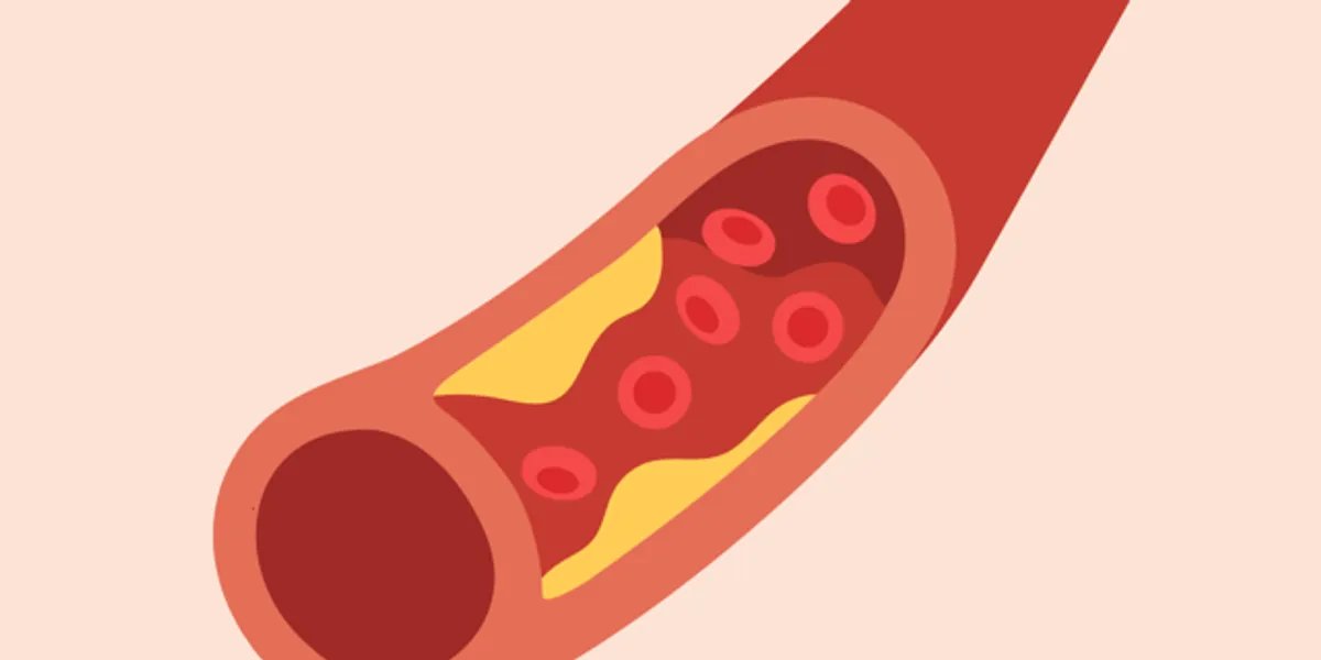 Healthy Women: Atherosclerosis and brain disease