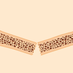 HealthyWomen- Solutions for fracture