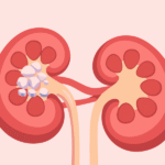 Symptoms of the primarian hiperoxaluria