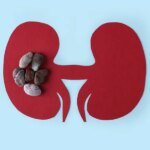 Healthy Women’s Kidney Stone Facts