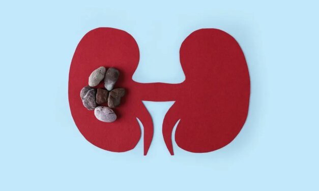 Healthy Women’s Kidney Stone Facts
