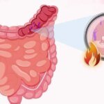Colorectal Cancer and the Gut Microbiome