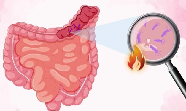 Colorectal Cancer and the Gut Microbiome