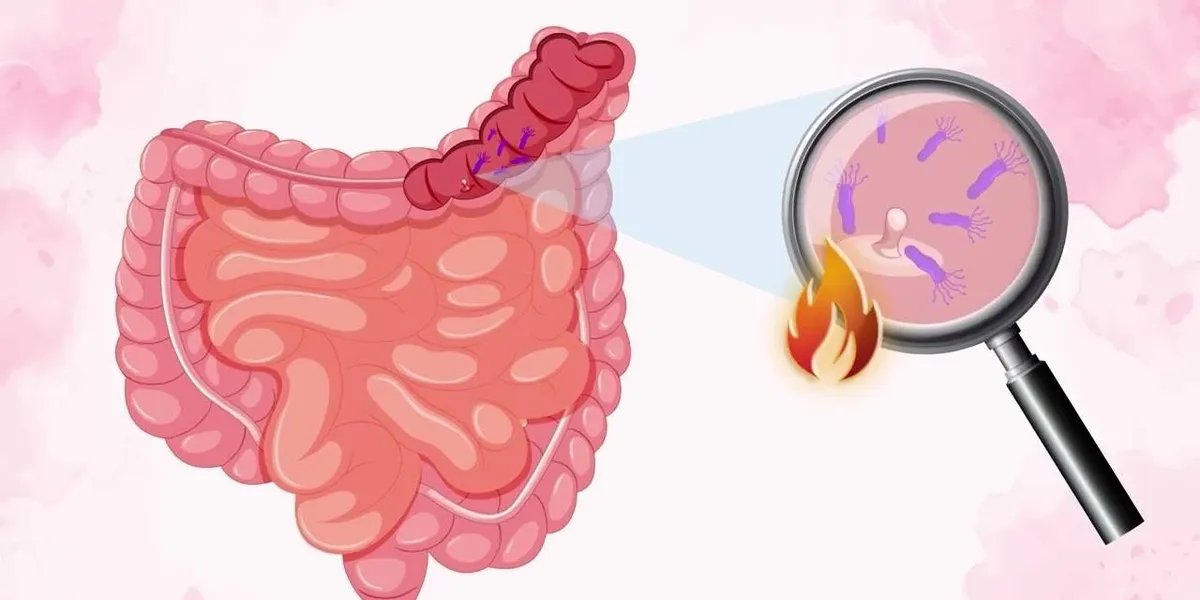 Colorectal Cancer and the Gut Microbiome