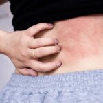 Chronic Spontaneous Urticαria įs a treatable condition.