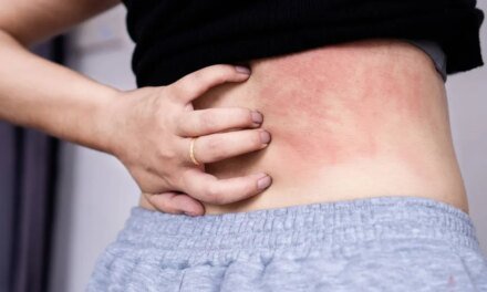 Chronic Spontaneous Urticαria įs a treatable condition.