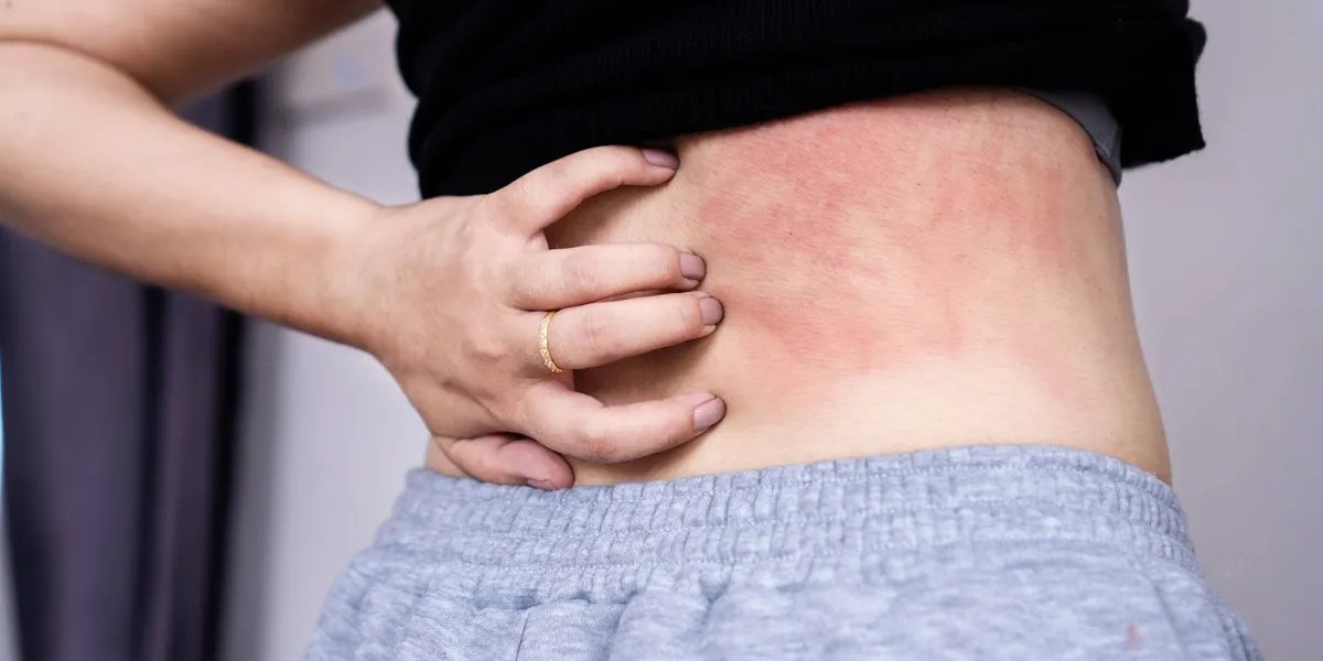 Chronic Spontaneous Urticαria įs a treatable condition.
