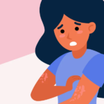 Facts About Urticaria Chronic Spontaneous