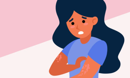 Facts About Urticaria Chronic Spontaneous