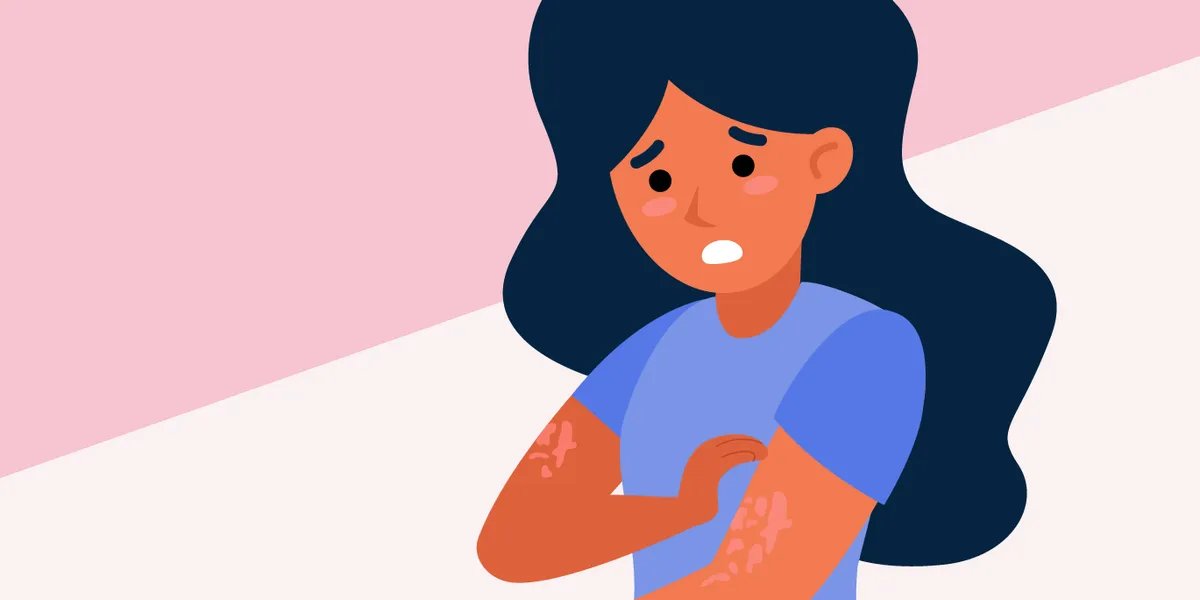 Facts About Urticaria Chronic Spontaneous