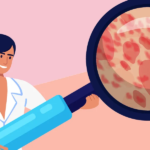 Chronic Spontaneous Urticaria: What Is It?
