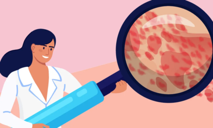 Chronic Spontaneous Urticaria: What Is It?