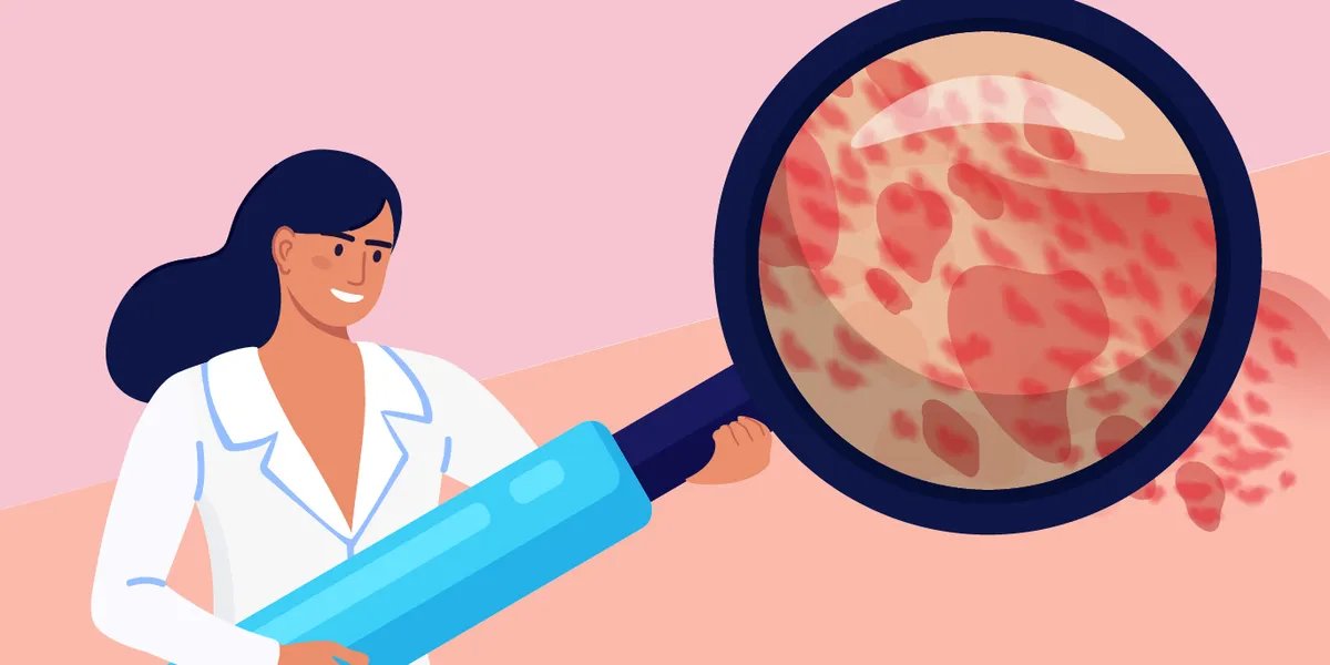 Chronic Spontaneous Urticaria: What Is It?