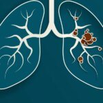 How Do Lung Most cancers Biomarkers Assist Information Remedy?