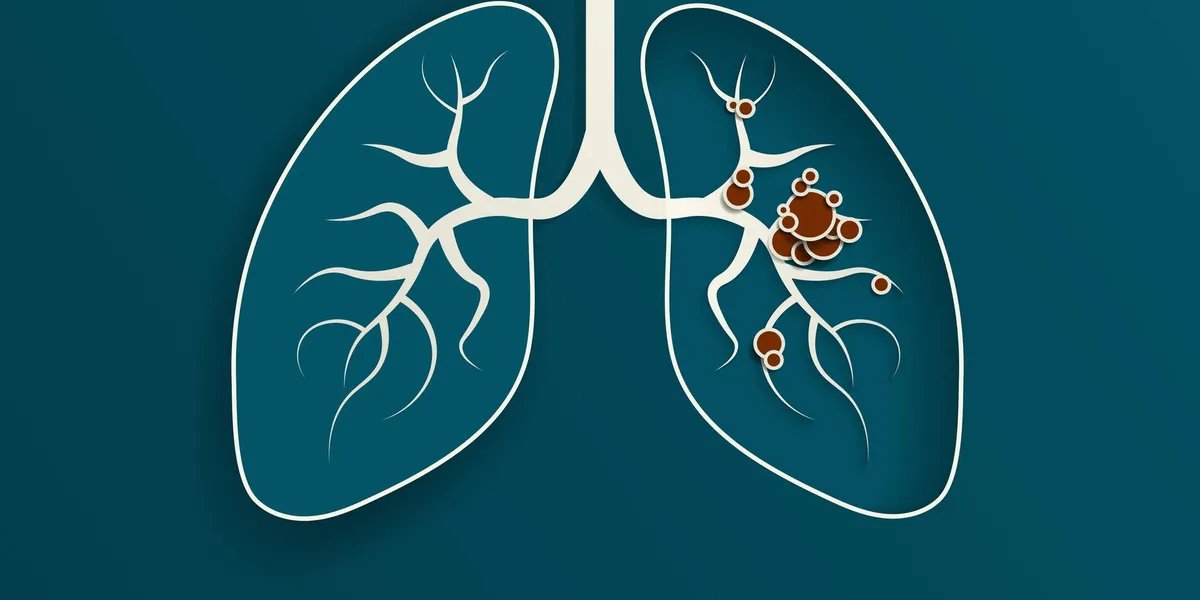 How Do Lung Most cancers Biomarkers Assist Information Remedy?