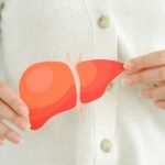 What Is MASLD, Also known as Fatty Liver Disease?